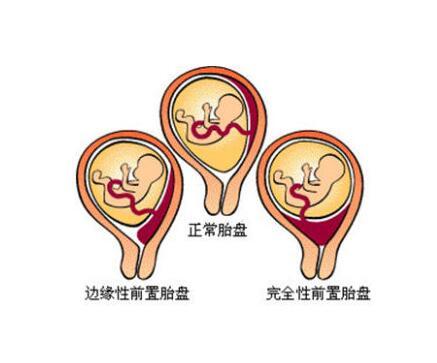 胎盘附着在子宫前壁是不是，是打麻醉引起的吗？