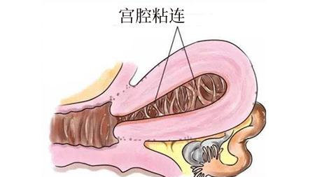 贝安健康：诊断宫腔粘连最准确的方法。