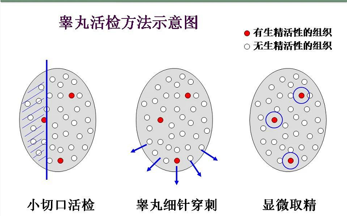 贝安健康：无精者为什么睾丸活检还能找到精子?