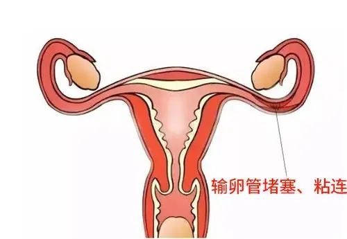 贝安健康：出现哪些情况不适合进行输卵管造影？