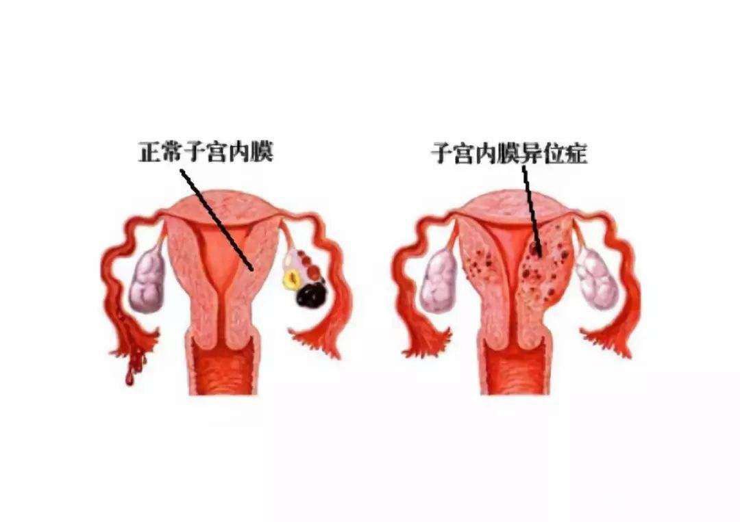 贝安健康：子宫内膜异位可以治愈吗？
