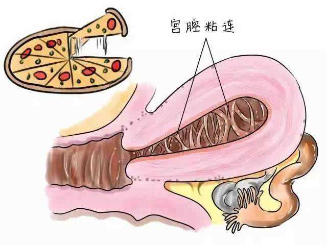 贝安健康：宫腔黏连复发率高吗？
