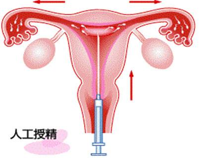 贝安健康：人工授精成功率高吗？