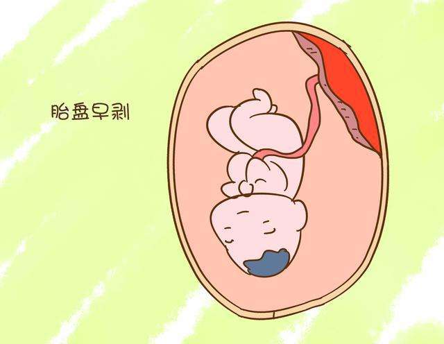 贝安健康：羊水过少有什么危害吗？