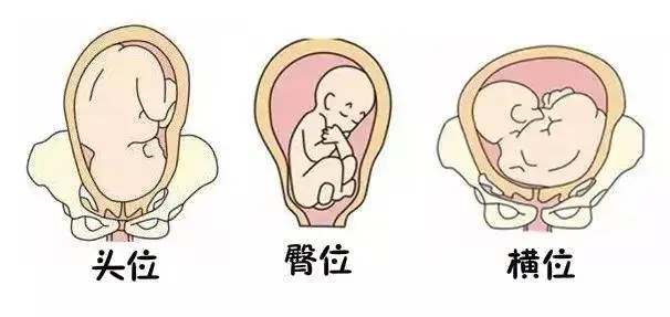 贝安健康：胎位分哪几种?