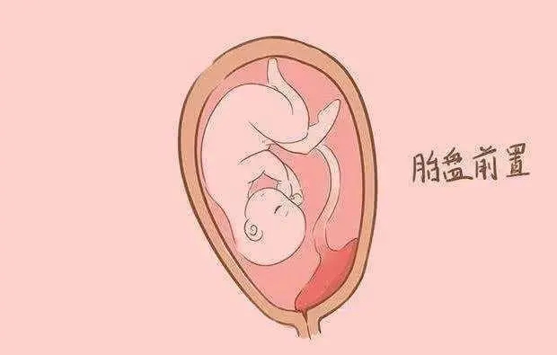 贝安健康：为什么会出现前置胎盘?