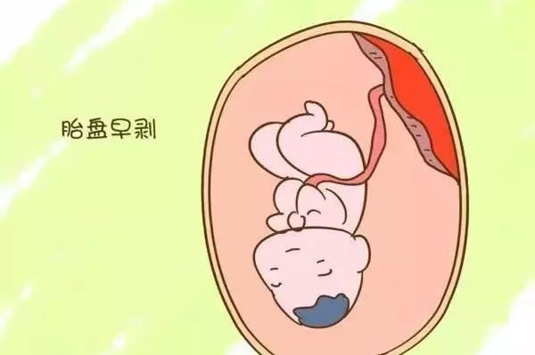 贝安健康：预防胎盘早剥该怎么做?