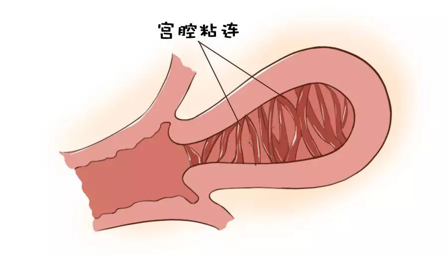 贝安健康：宫腔粘连怀孕怎么处理?